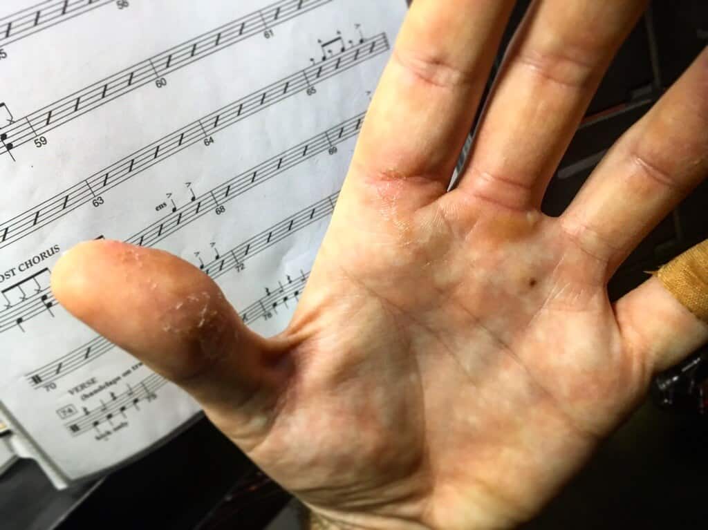 Chaz Chambers showing cracked hands after playing more than 50 Ringling Bros. shows in Houston